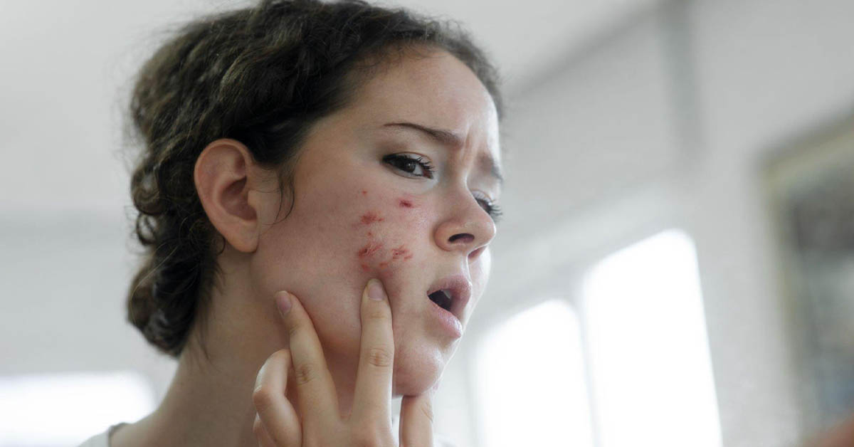 Breaking Down the Science: Can Pre-Workouts Really Cause Acne?