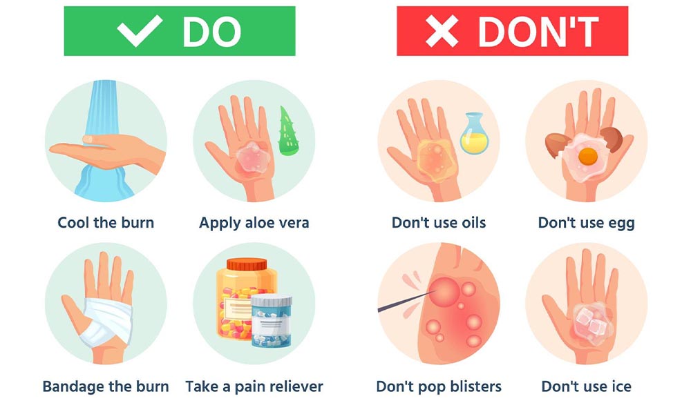 Proper Home Remedies for Treating Burns