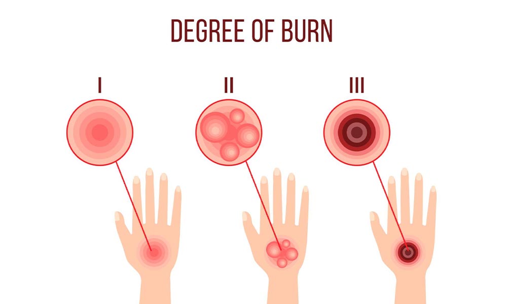 Understanding Burns and Their Severity