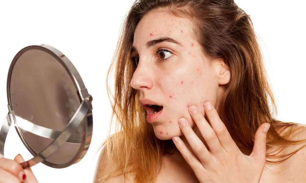 Understanding the Science behind Acne
