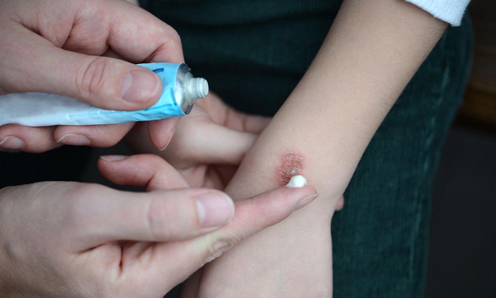 The Truth About Putting Toothpaste on Burns: Does It Really Cause Irritation?
